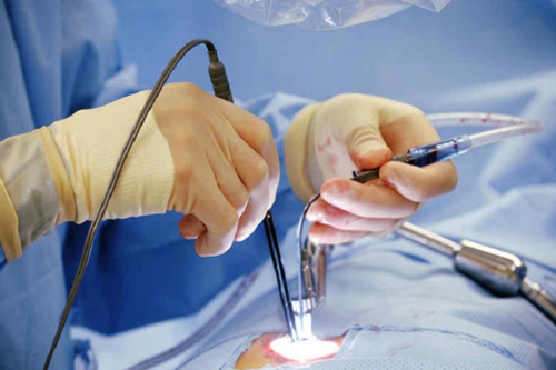 Endoscopic Spine Surgery operation performed by doctor