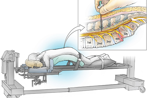 Awake Spine Surgery structure shows patient positioned and treatment