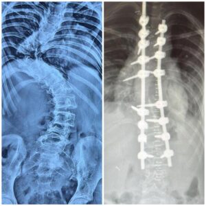 Correction of Acute Hairpin Thoracic Curve with Corpectomy and Laminectomy