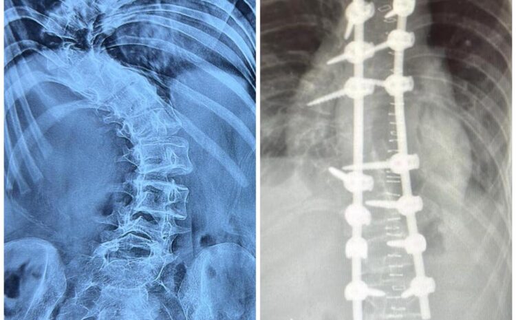 Correction of Acute Hairpin Thoracic Curve with Corpectomy and Laminectomy