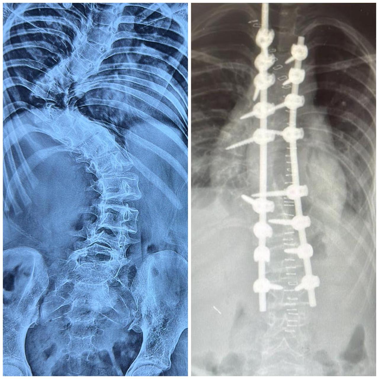 Correction of Acute Hairpin Thoracic Curve with Corpectomy and Laminectomy