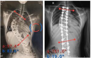 Correction of a Severe 90° Spinal Curve with Pedicle Subtraction Osteotomy