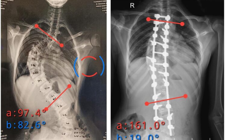 Correction of a Severe 90° Spinal Curve with Pedicle Subtraction Osteotomy