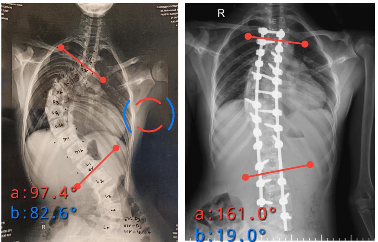 Correction of a Severe 90° Spinal Curve with Pedicle Subtraction Osteotomy