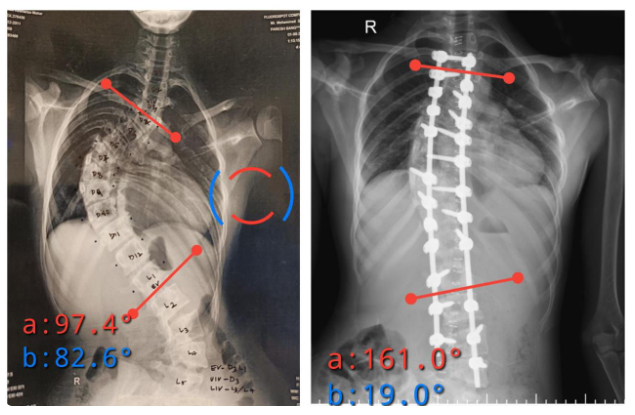 Scoliosis and Its Surgical Correction